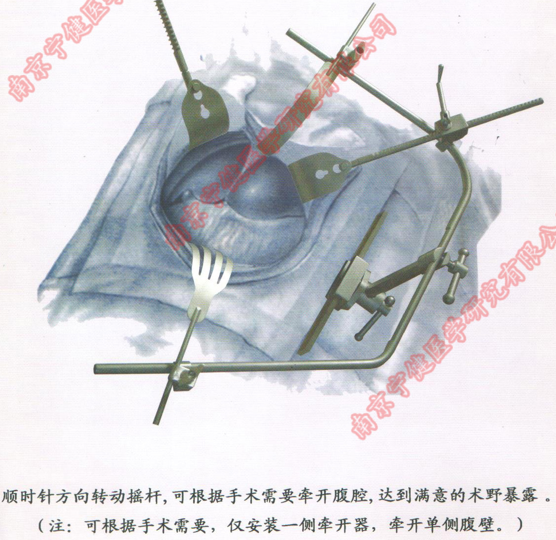腹部手术牵开器